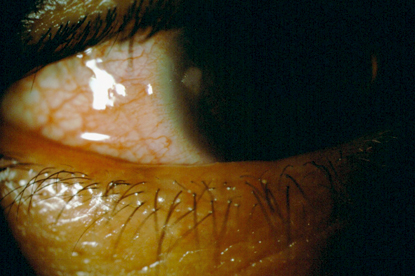 Kontaktlinsen und Komplikationen